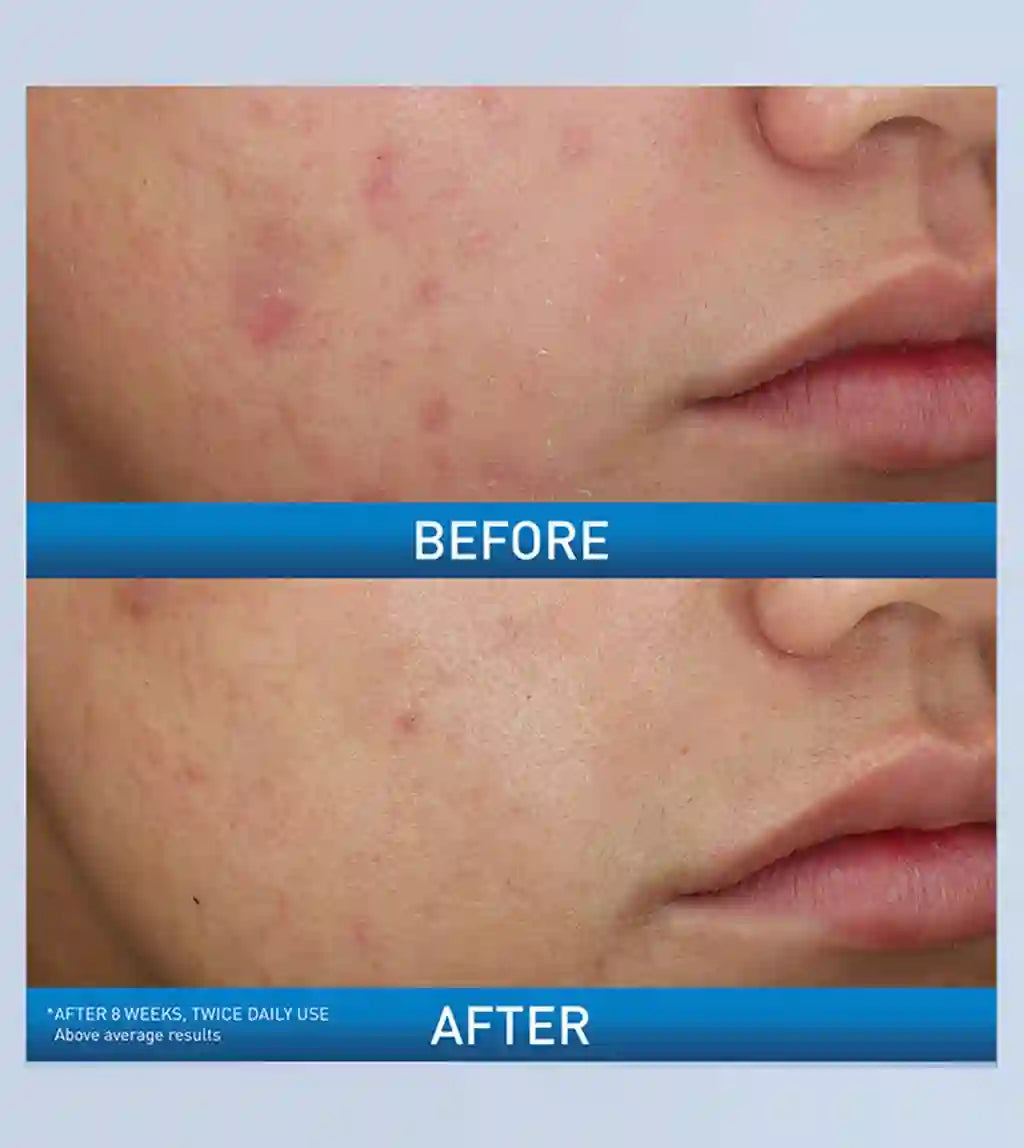 cerave Acne Foaming Cream Wash